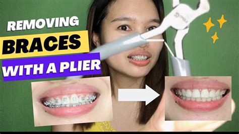 how to remove metal brackets from teeth|how to remove braces permanently.